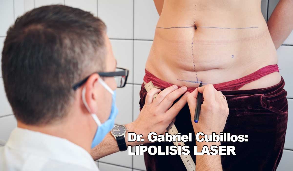 Dr. Gabriel Cubillos: Lipo láser ¿para qué sirve?